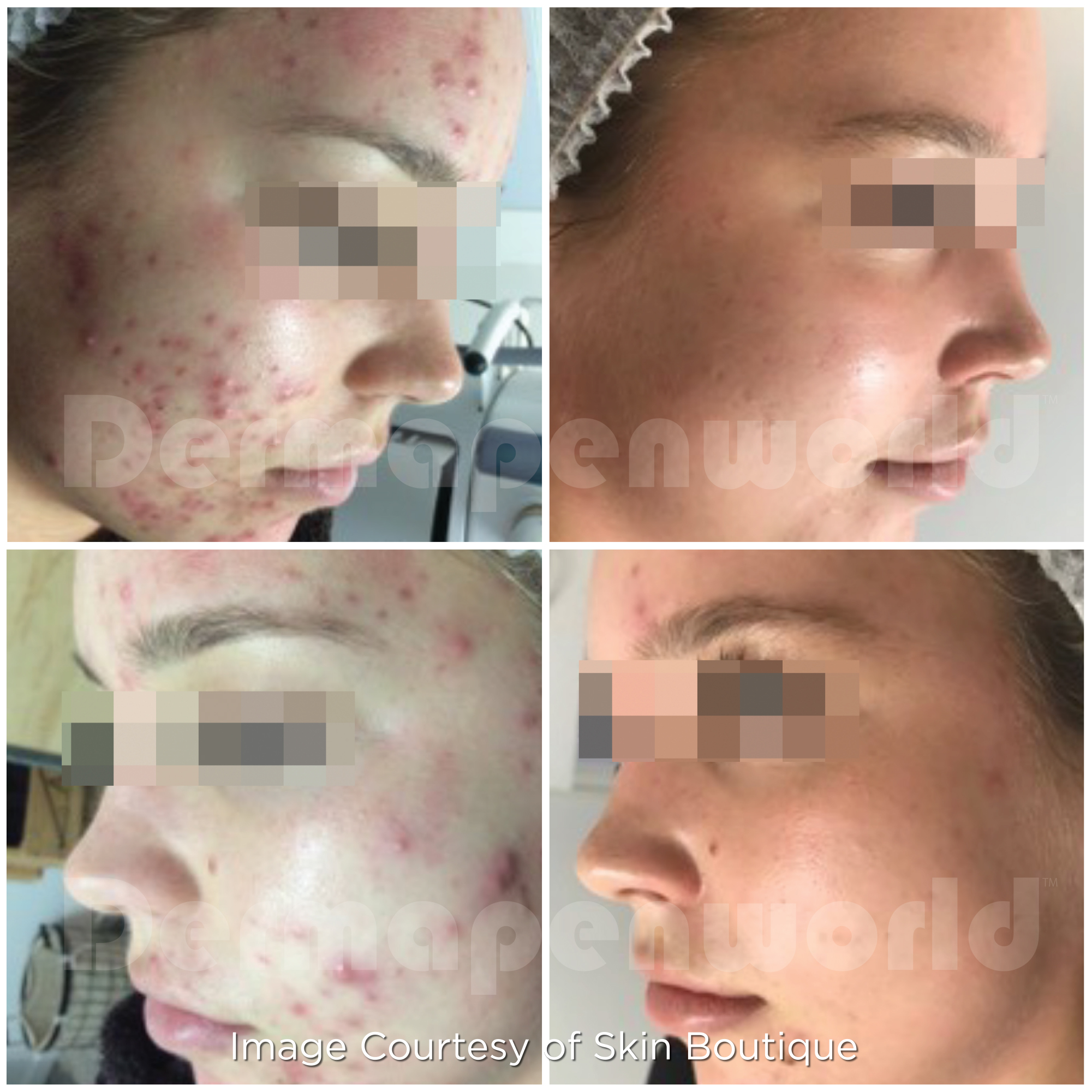 Before and After - Acne & Problematic Skin