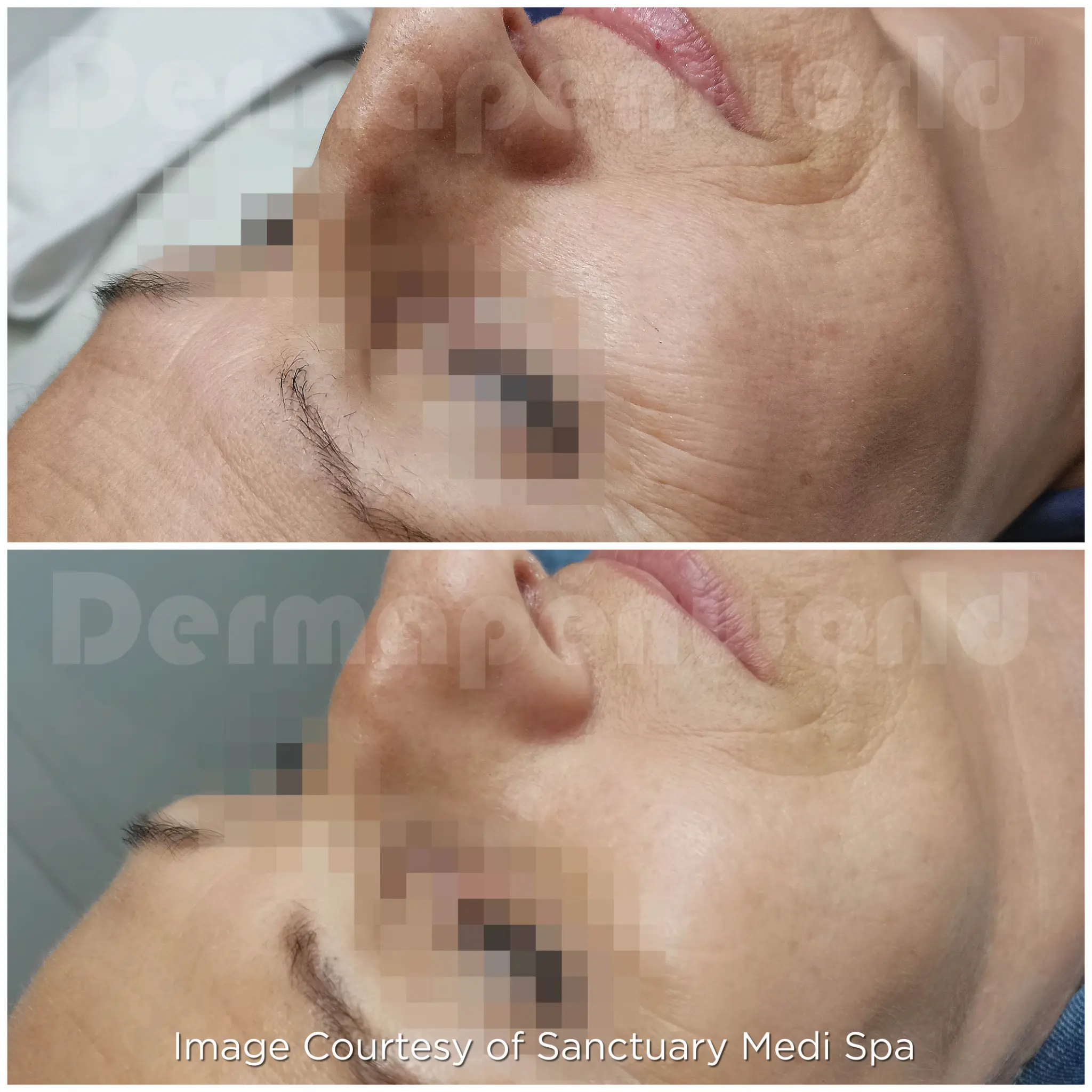 Before and After - Aging & Rhytids