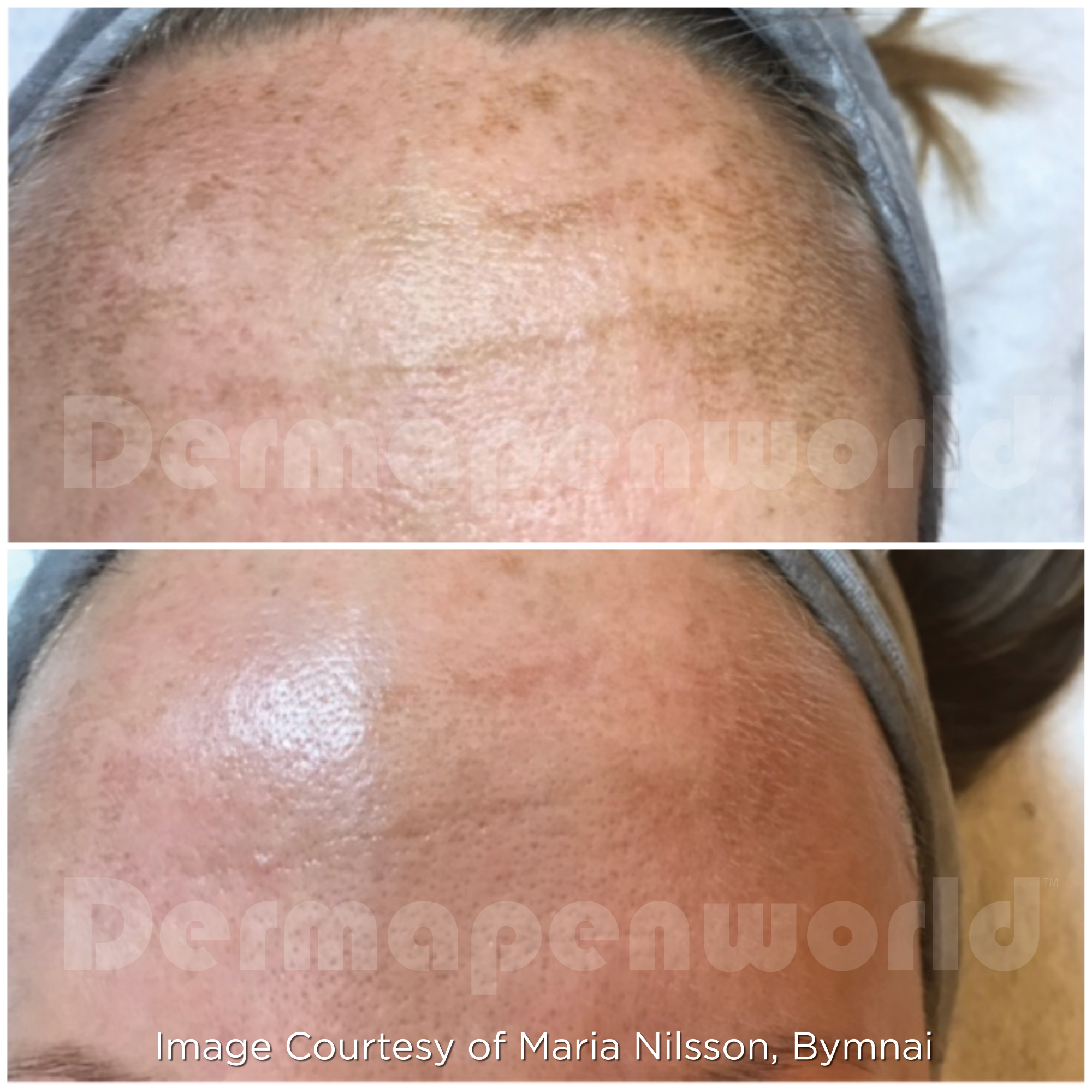 Before and After - Pigmentation